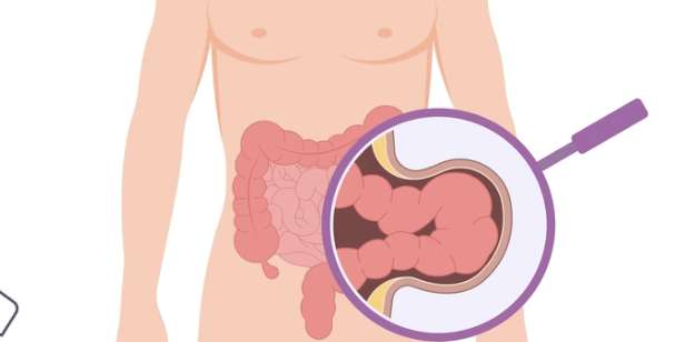 Fıtık Nedir? Belirtileri ve Tedavi Yöntemleri Nelerdir?