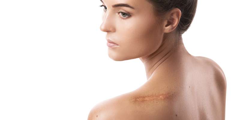 Keloid Nedir? Belirti ve Tedavi Yöntemi
