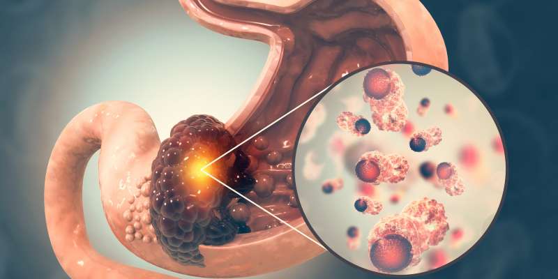 Mide Kanseri Nedir? Mide Kanseri Belirtileri, Nedenleri ve Tedavisi