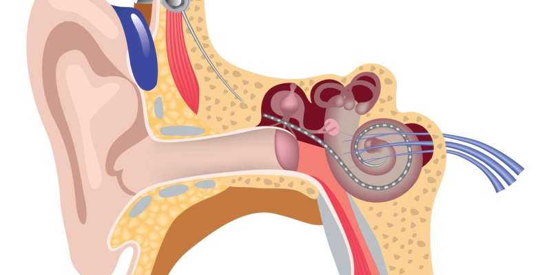 Koklear İmplant (Biyonik Kulak) Nedir? Koklear İmplantın Faydaları Nelerdir?